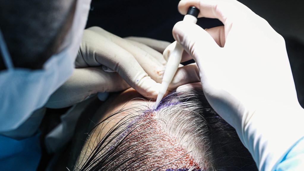 europe clinic turkey dhi hair transplant